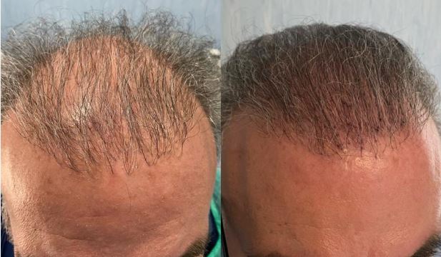 زراعة الشعر بالألياف الحيوية