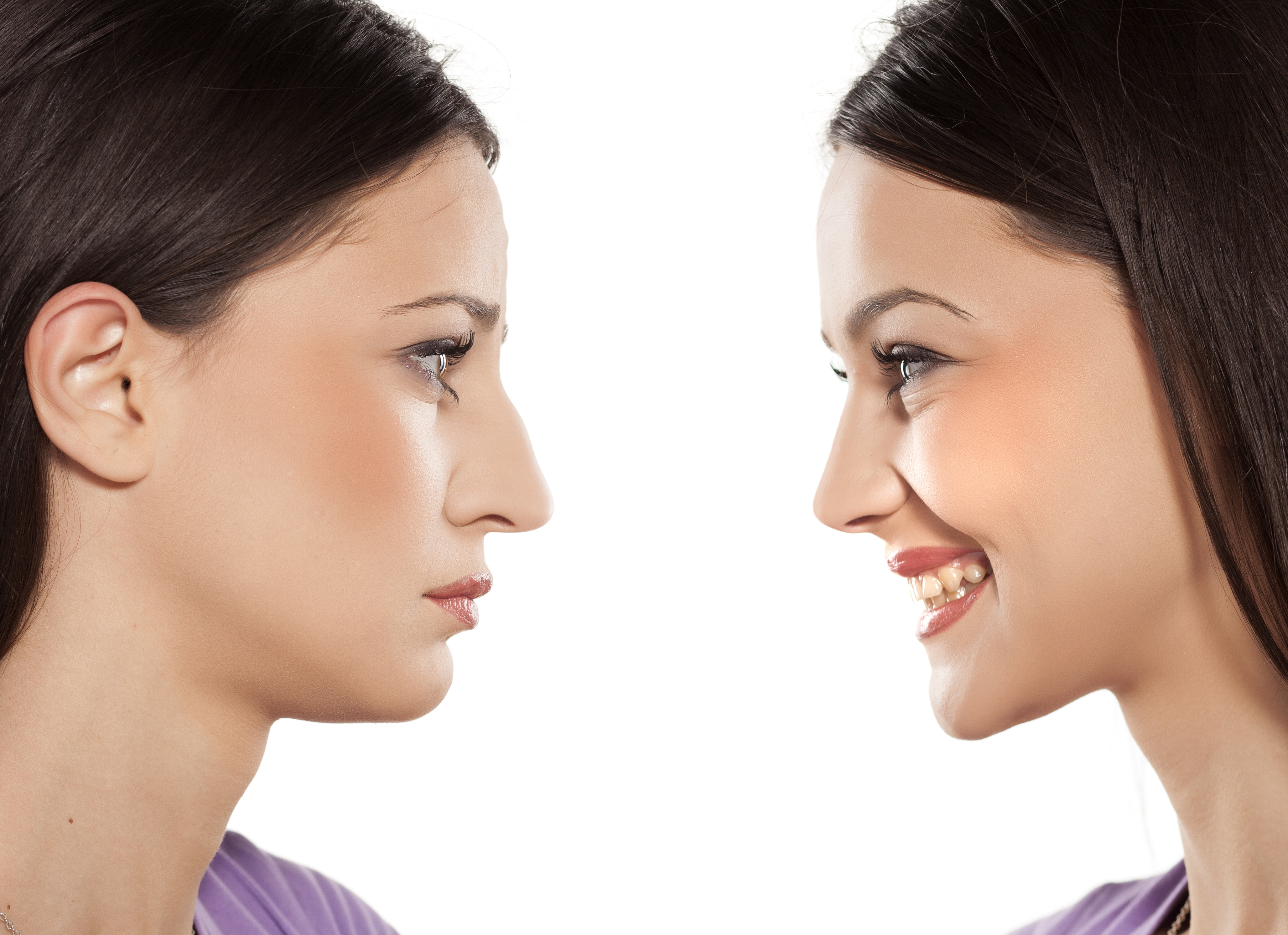Rhinoplasty