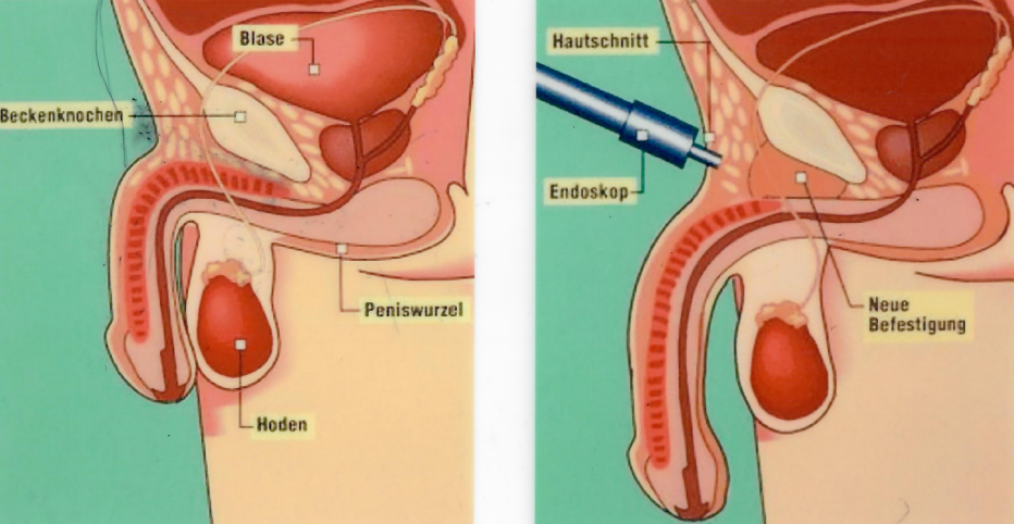 penispumpe vorher nachher Preise und Paketangebote für Penisimplantatchirurgie 2026 main image 1