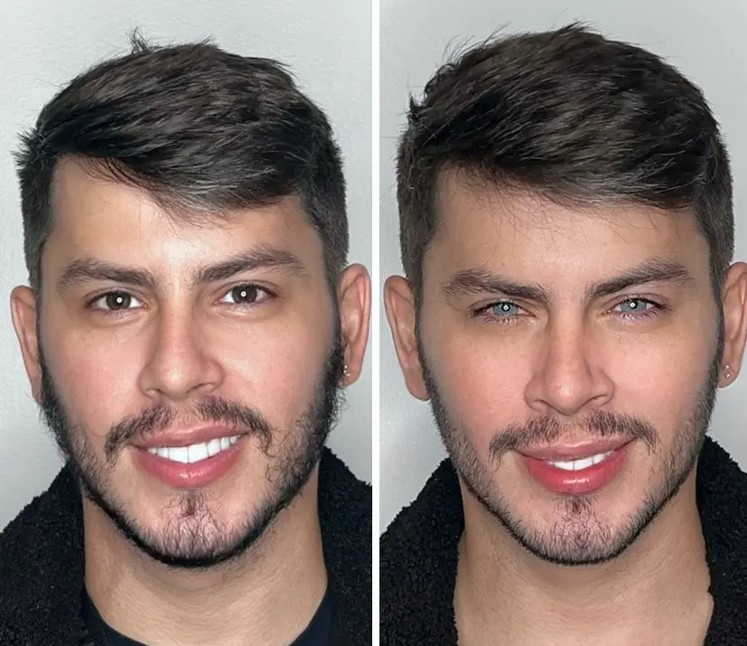 eye color change procedure