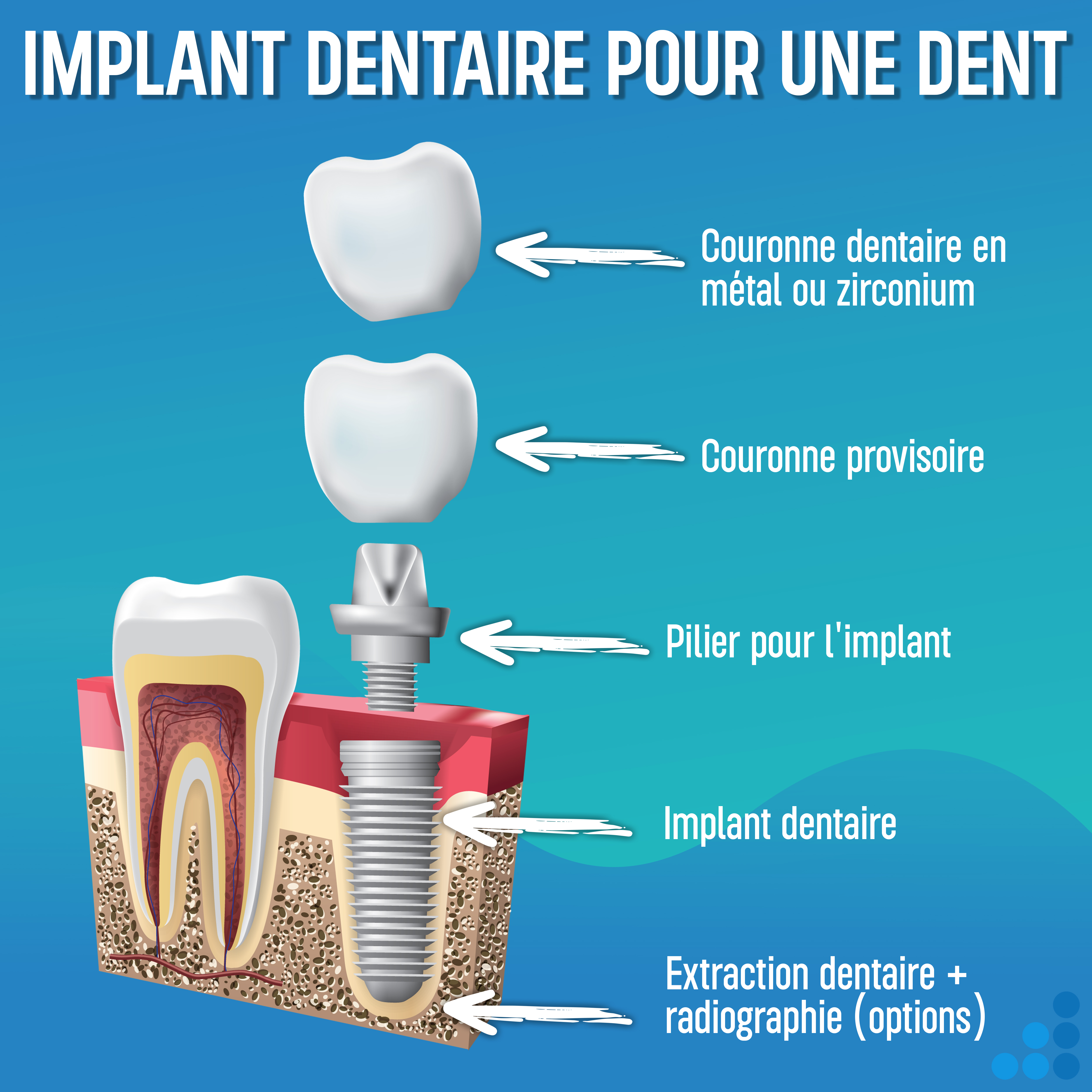 Guide implants dentaires 2026 : FAQ, prix et destinations